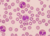 一种神秘颗粒被发明了！它能否成为败血症早筛标记物？？？？？？？？