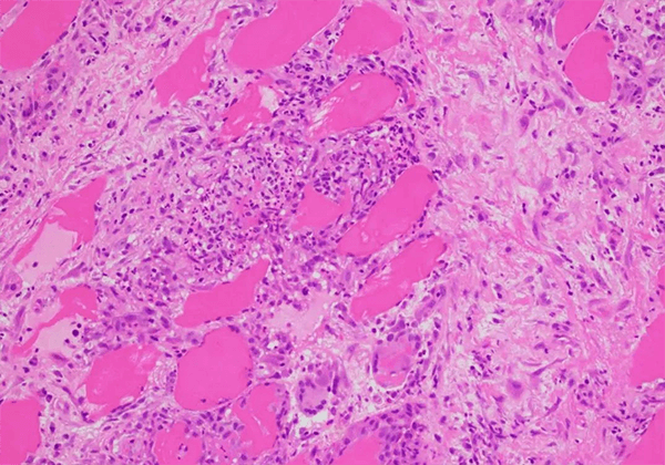 【威客电竞助力】治疗结节病的KBMAB-16获FDA批准临床